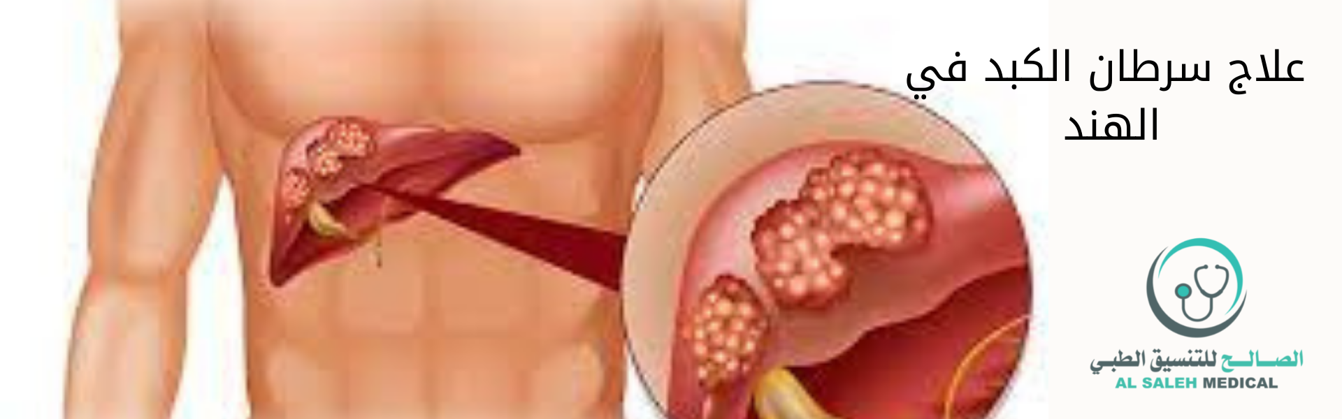 علاج سرطان الكبد في الهند| تجارب المرضى والتكاليف
